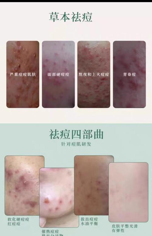 祛斑祛痘该选什么护肤品?-图2 祛斑祛痘该选什么护肤品?-图2