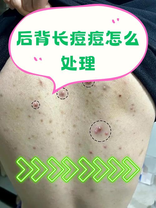 Lush脸部背部祛痘效果如何?-图1 Lush脸部背部祛痘效果如何?-图1