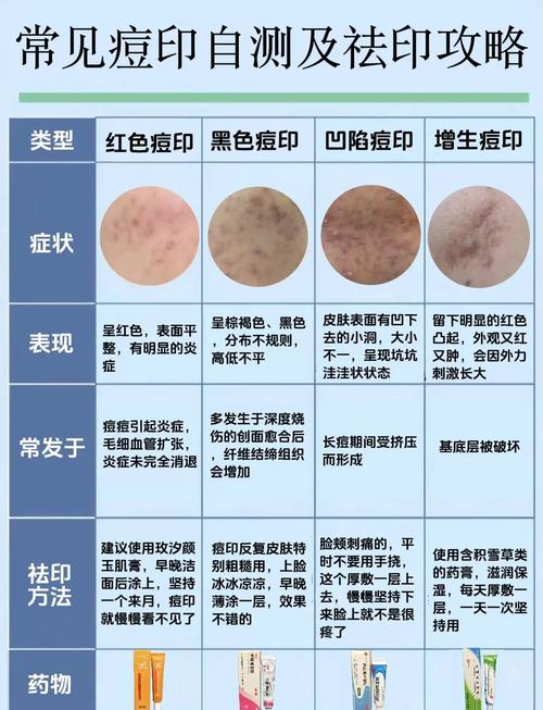 祛痘痕痘印,家用怎么弄才有效?-图1 祛痘痕痘印,家用怎么弄才有效?-图1