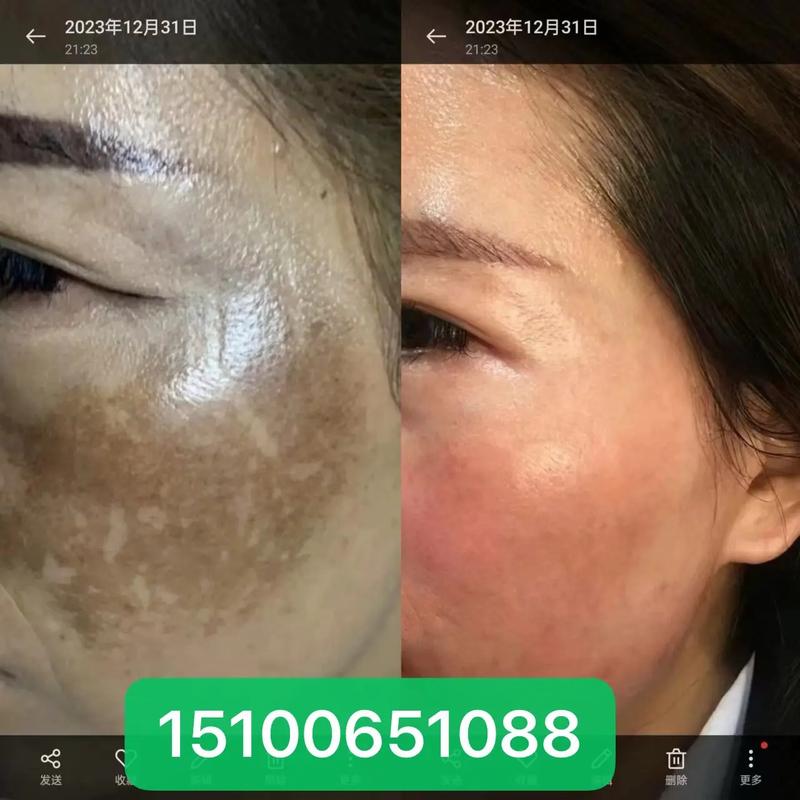 中药祛痘祛斑会反弹不-图1