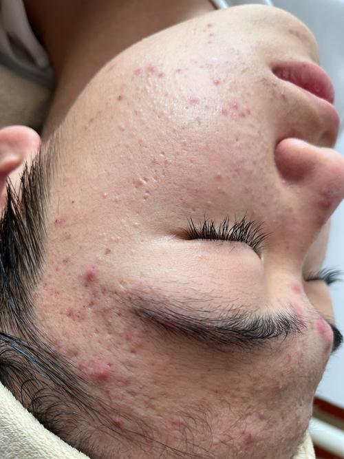 中药祛痘祛斑会反弹不-图3