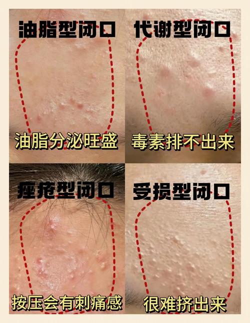 西姿能祛痘和封闭粉刺吗?-图2 西姿能祛痘和封闭粉刺吗?-图2