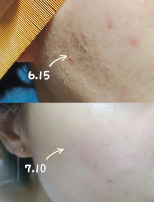 西姿能祛痘和封闭粉刺吗?-图3 西姿能祛痘和封闭粉刺吗?-图3