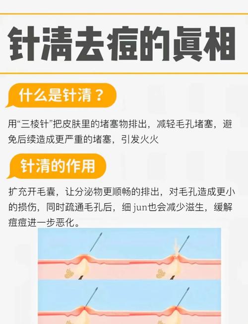 排痘针祛痘会留痘印吗?-图1 排痘针祛痘会留痘印吗?-图1