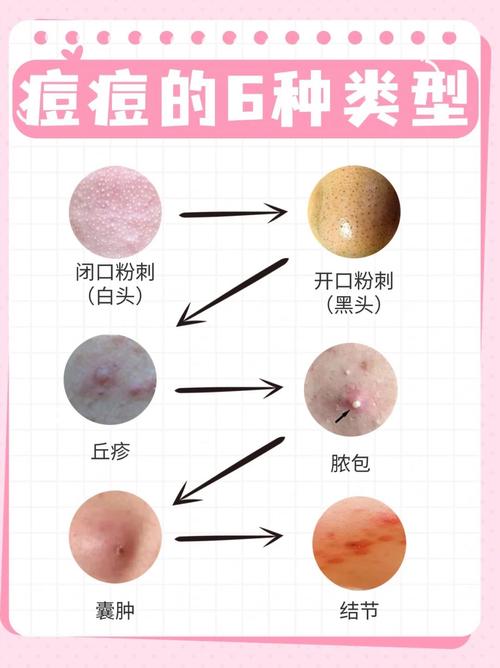 排痘针祛痘会留痘印吗？-图2