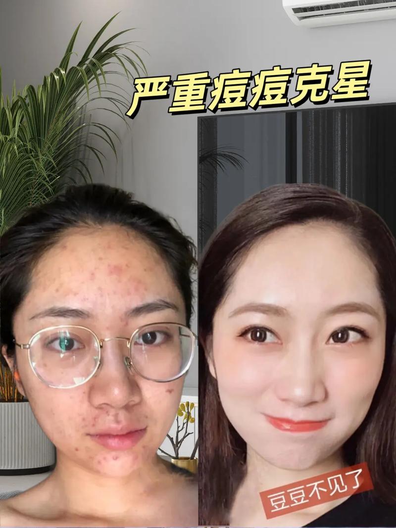 脸上长痘，祛痘到底什么方法最好？-图2