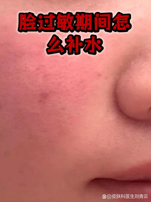 过敏后多久能安全用护肤品？-图2