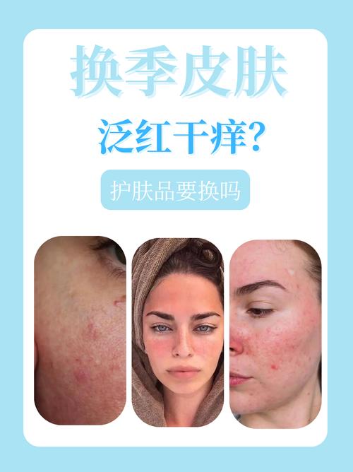 过敏后多久能安全用护肤品？-图1