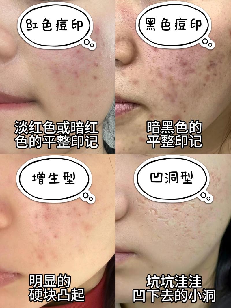 祛痘满了痘印怎么处理-图2