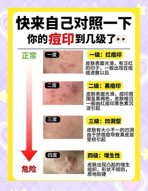 祛痘满了痘印怎么处理-图3