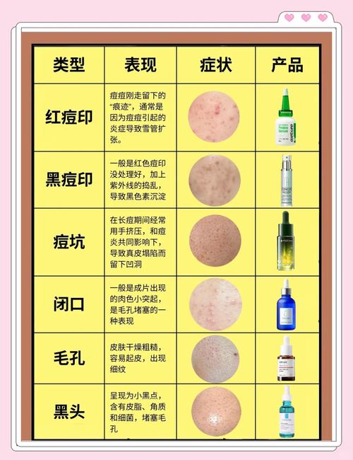 男士祛痘痘印怎么快速搞定？-图1