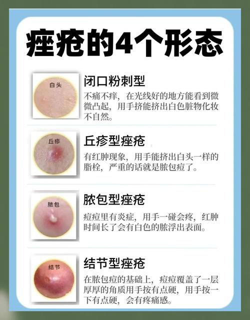 男士祛痘痘印怎么快速搞定？-图2