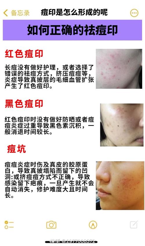 男士祛痘痘印怎么快速搞定？-图3