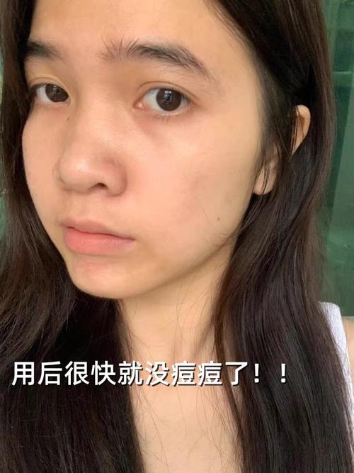 祛痘产品反而致痘，是哪里出问题了？-图1
