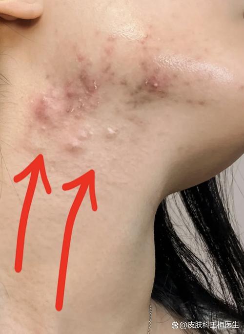 下巴长痘用祛痘老偏方有效吗？-图3