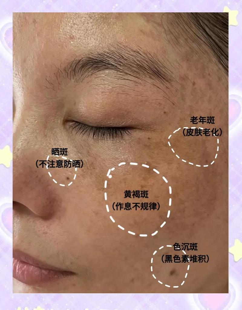 哪些护肤品用后反而会致长斑?-图2 哪些护肤品用后反而会致长斑?-图2