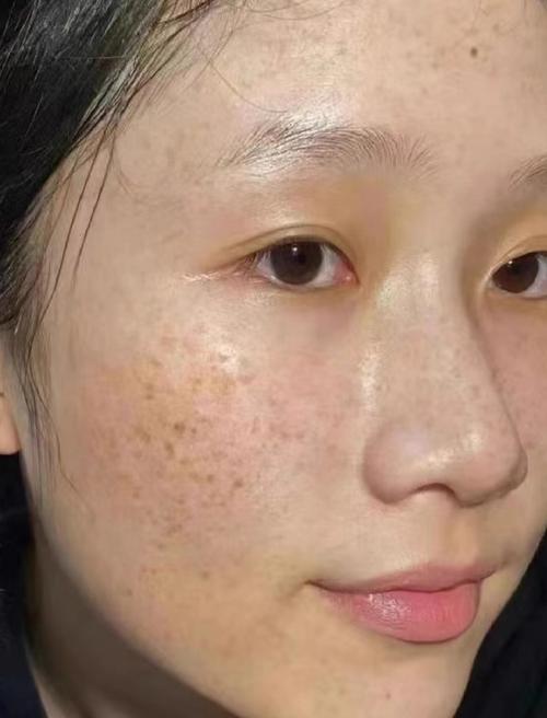 哪些护肤品用后反而会致长斑?-图3 哪些护肤品用后反而会致长斑?-图3