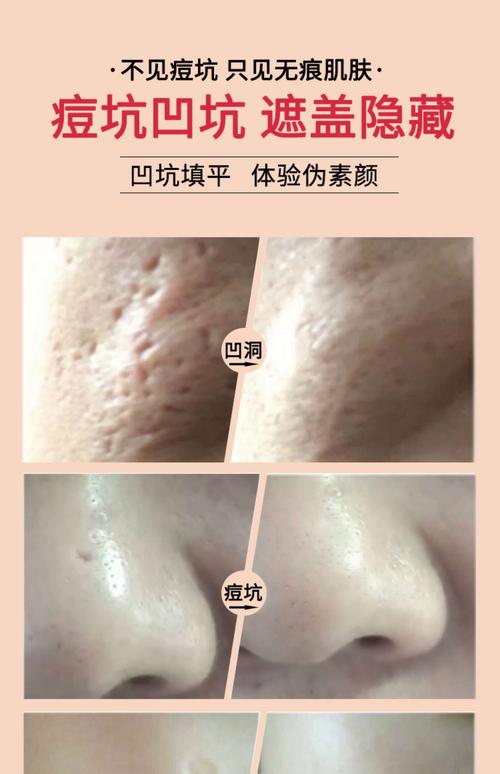泡什么能祛痘祛印祛坑？-图3
