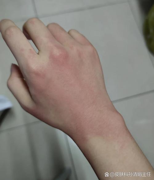 护肤品用几天才过敏，是哪里出了问题？-图2