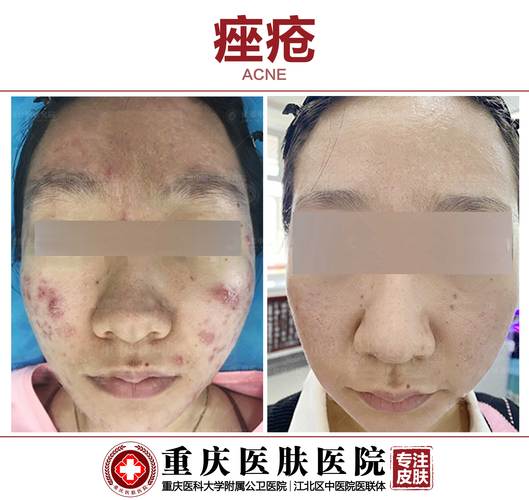 Doctor g祛痘真的有效吗？-图2