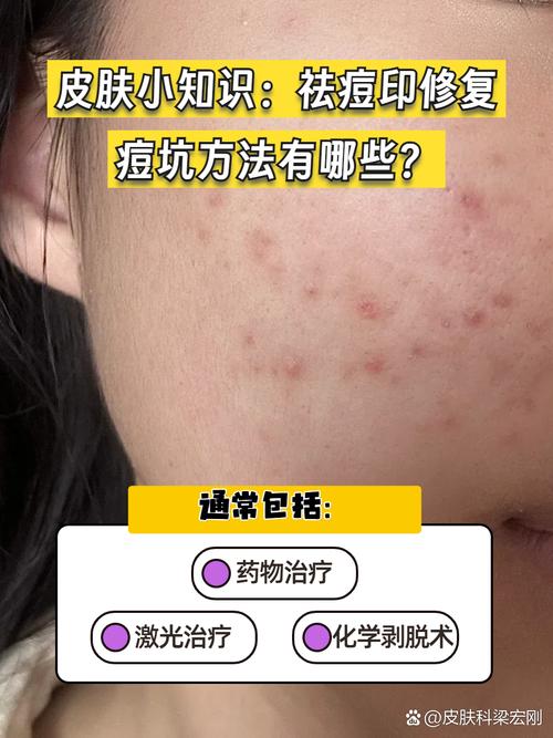 PCA Skin祛痘效果真的好吗？-图2