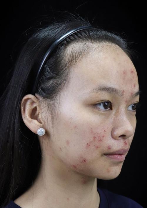 PCA Skin祛痘效果真的好吗？-图3