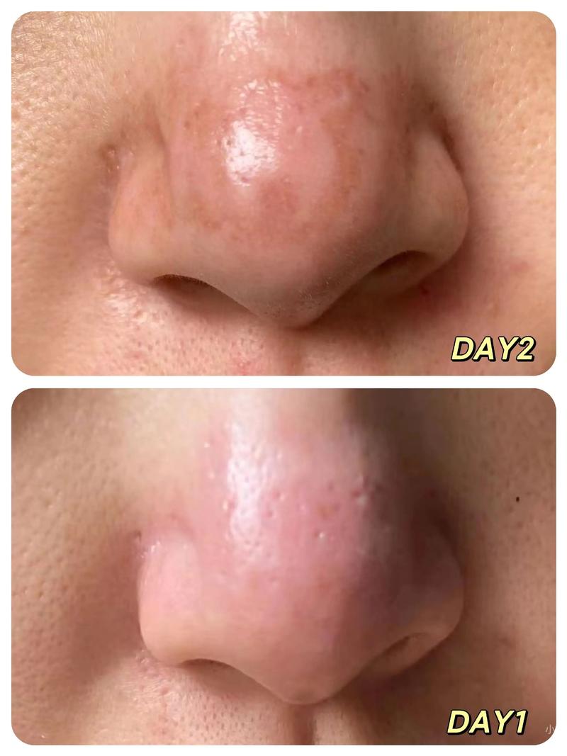 Sampar祛痘效果真的好吗？-图1