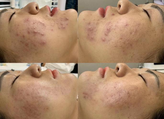 Sampar祛痘效果真的好吗？-图2