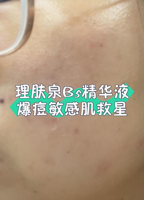 理泉祛痘会爆痘吗？-图2