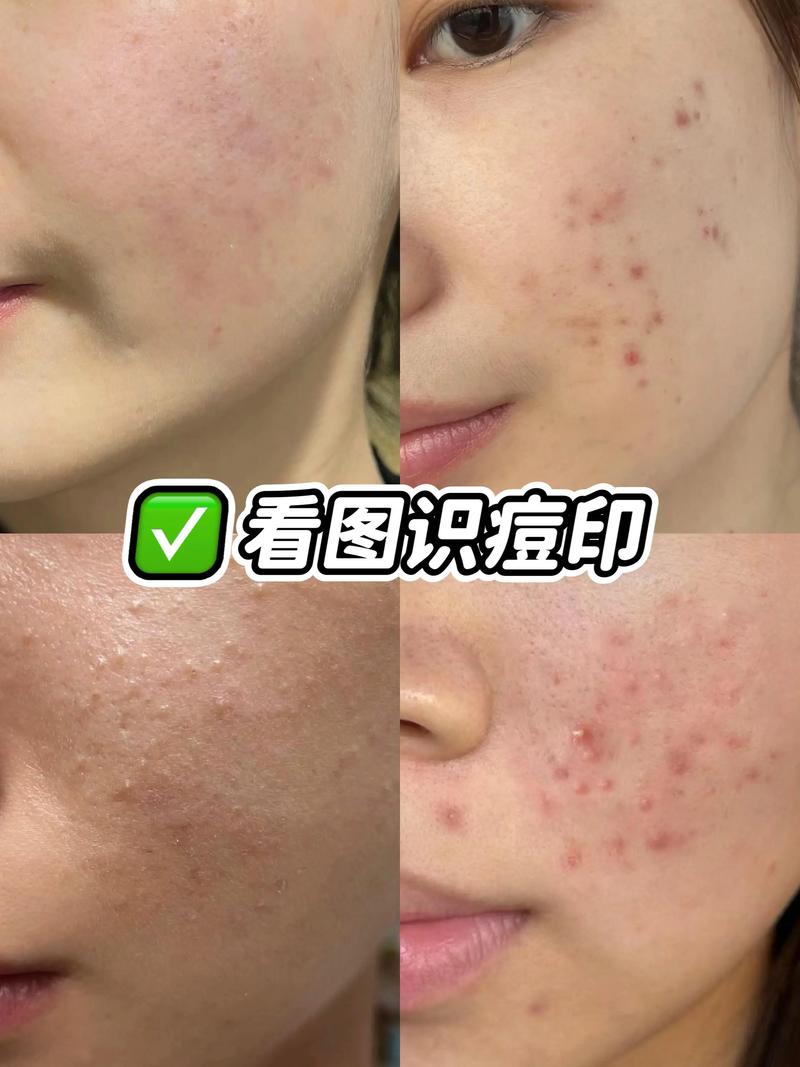 葱白真的能祛痘印吗？-图2