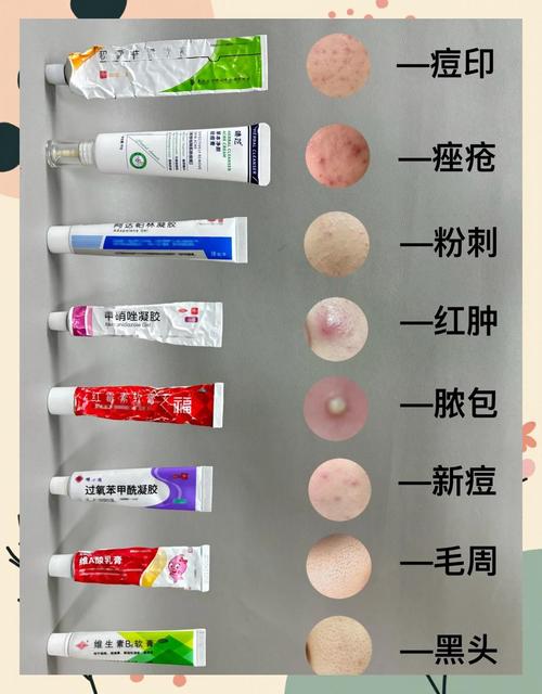 祛痘药膏能去痘印吗？-图1