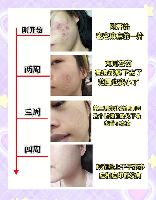 祛痘印贴该先祛痘还是先美白？-图2