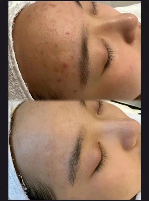 激光祛痘祛痘印有副作用吗？-图1