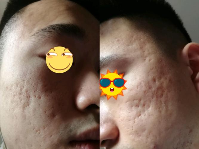 男士痘印痘疤凹洞怎么祛？-图2