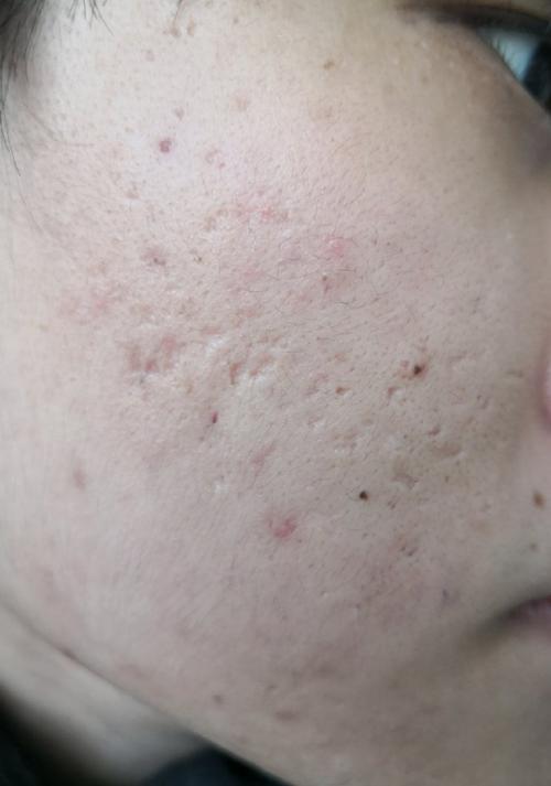 男士痘印痘疤凹洞怎么祛？-图3