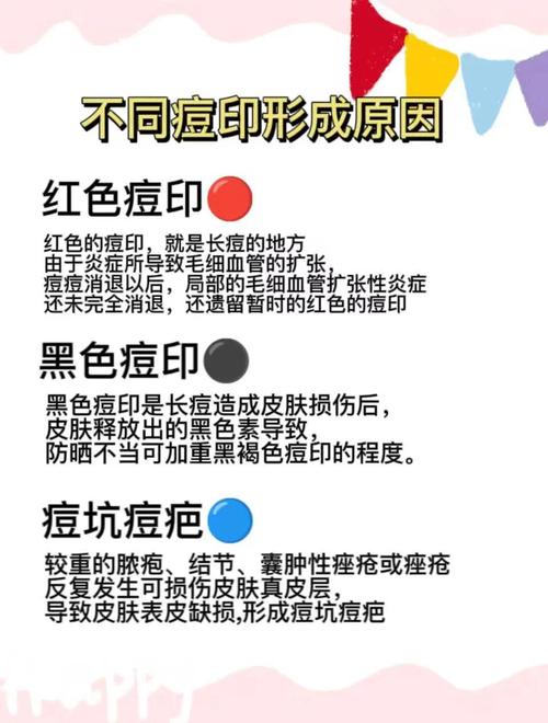 祛痘祛痘印，哪些方法最有效？-图2