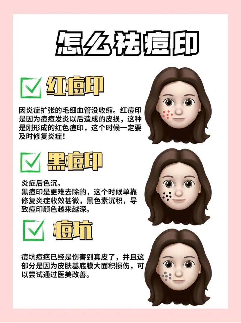祛痘祛痘印，哪些方法最有效？-图3