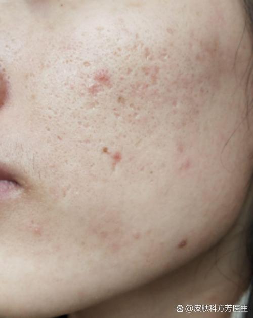 激光祛痘坑祛痘真的安全吗？-图3