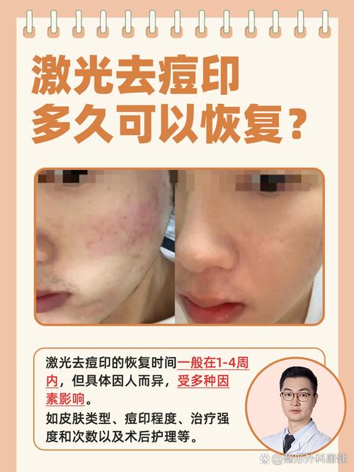 激光祛痘还是祛痘印？效果有何不同？-图1