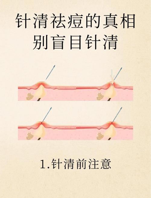 祛痘机构祛痘到底靠什么？-图3