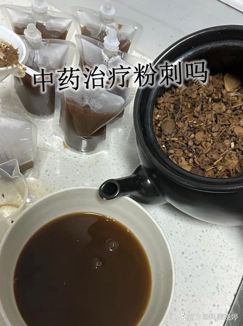 中药世家祛痘真的能祛痘吗？-图3