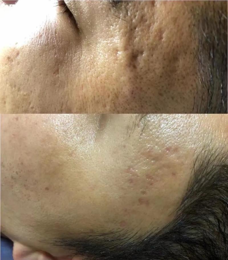 祛痘印、痘坑能一起修复吗？-图1