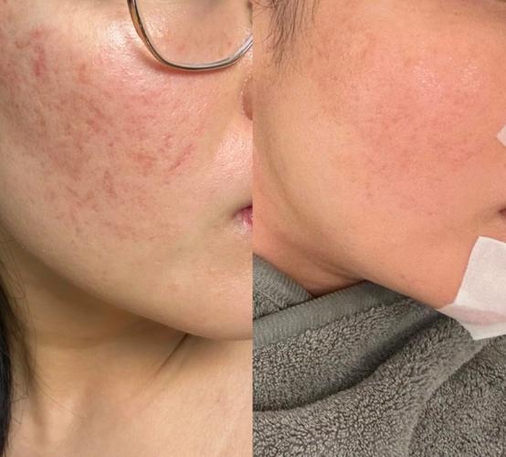 祛痘印、痘坑能一起修复吗？-图2