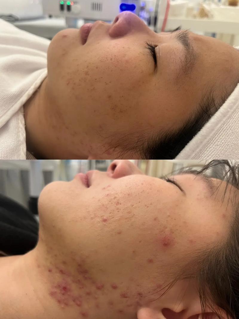 火山岩祛痘真的有效吗？-图3