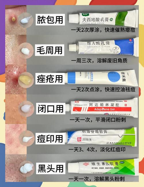 祛痘酸奶怎么选？-图3