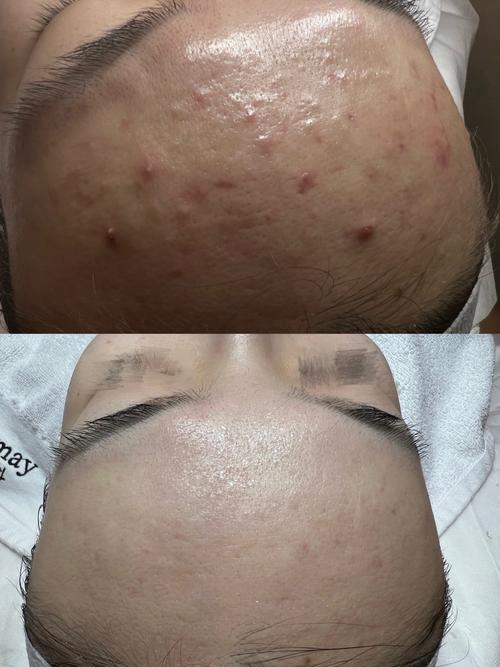 祛痘师和美容师哪个好-图2