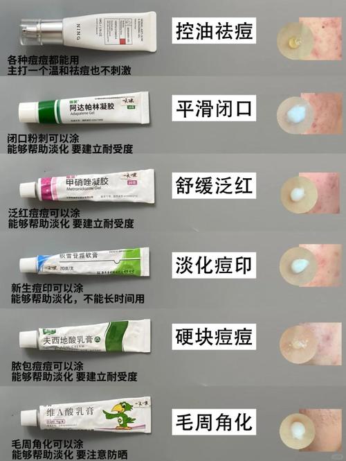 祛痘后该擦什么产品?-图2 祛痘后该擦什么产品?-图2