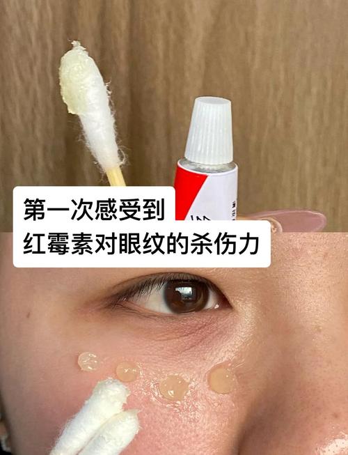 红霉素眼膏真能祛痘印吗？-图1
