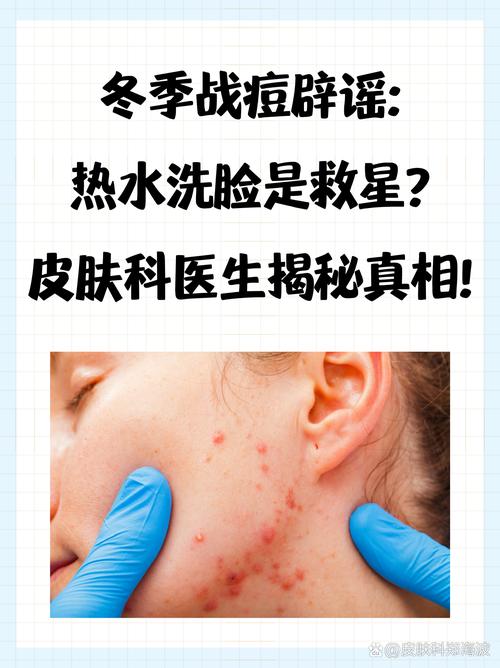 温盐水洗脸真能祛痘吗？-图1