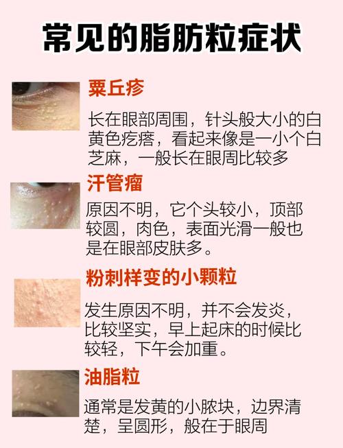 护肤品用着就长脂肪粒怎么办?-图1 护肤品用着就长脂肪粒怎么办?-图1